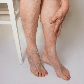 Varizes e Microvarizes
